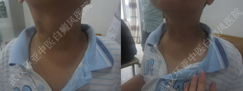 5岁小孩颈部出现多片点状白斑4.jpg