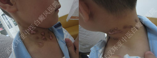 5岁小孩颈部出现多片点状白斑3.jpg