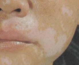 武汉脸上的白斑是白癜风需要怎么确诊？